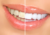Teeth Whitening Greensboro Before and After